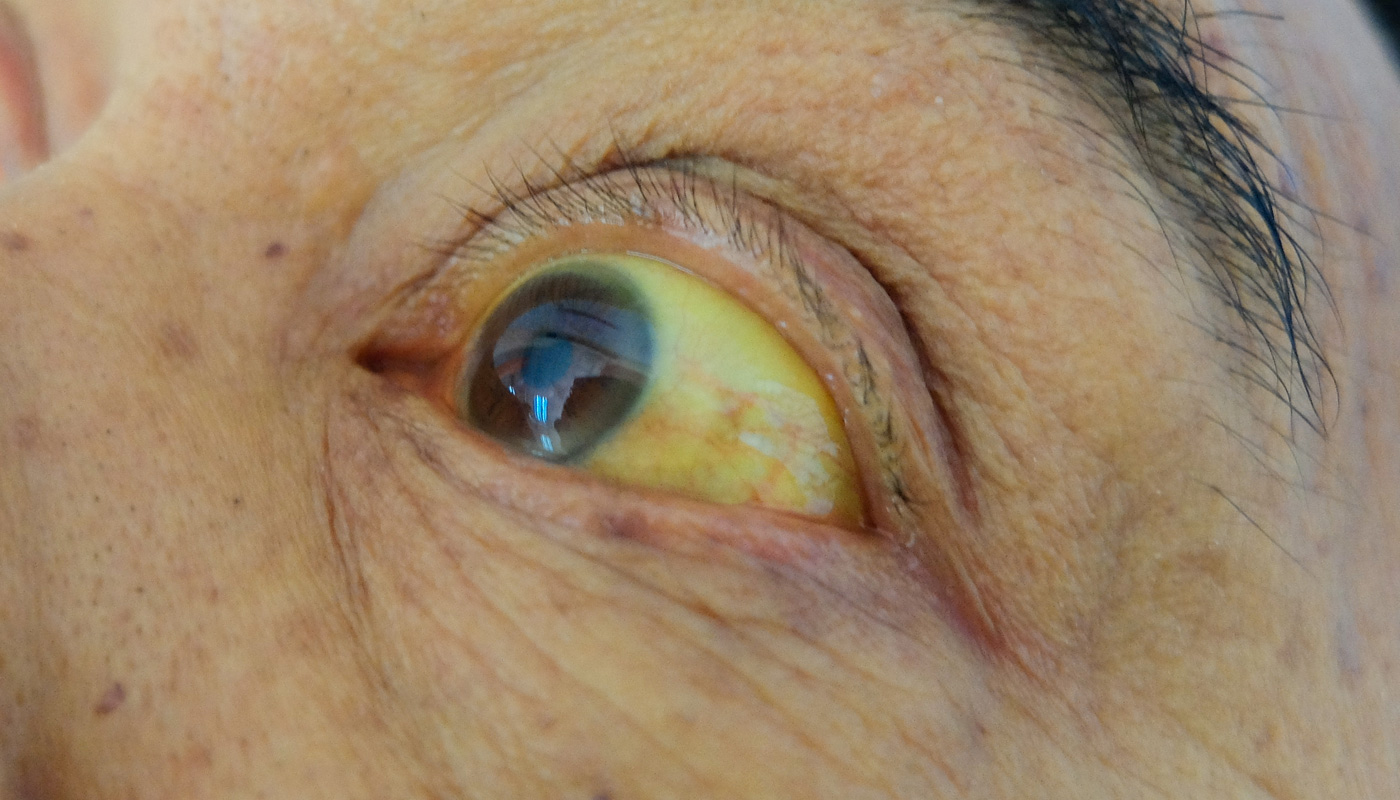 Olhos amarelados: o que pode ser?